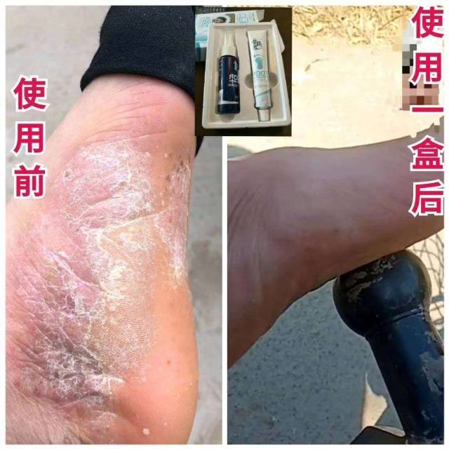 真菌克星解决皮肤疑难杂症真菌水泡发痒脱皮烂脚丫香港脚